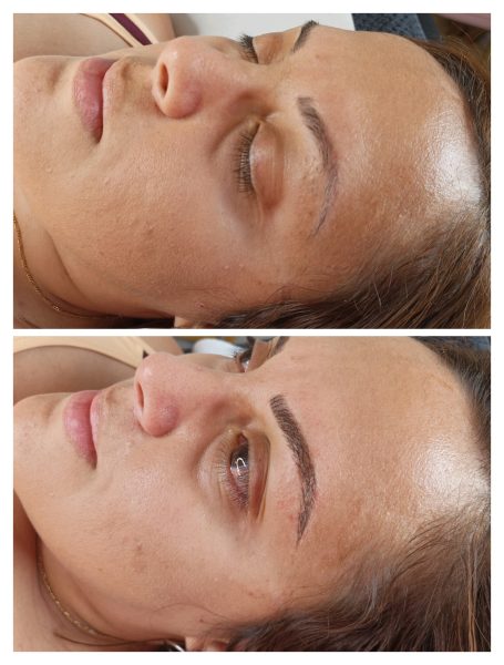 Avant et après un traitement de beauté sur le visage d'une femme, montrant une amélioration.