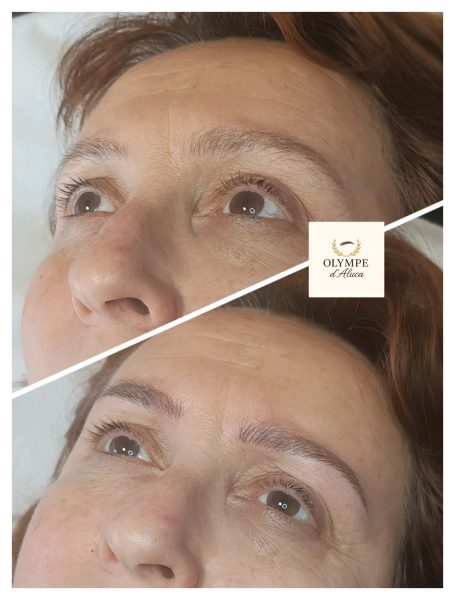 Avant et après d'un traitement des sourcils sur un visage de femme.